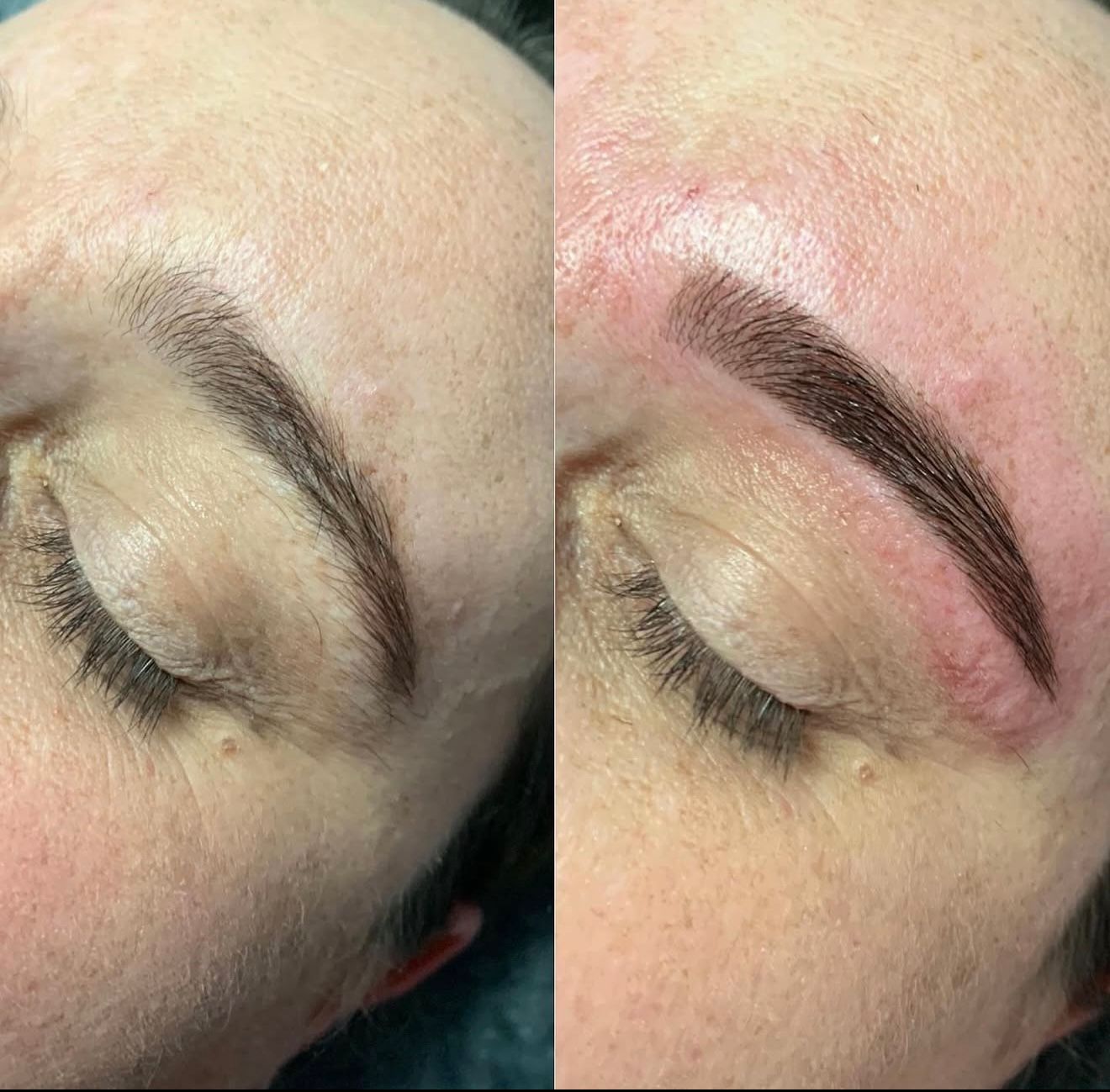 Side view brow transformation